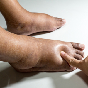 Pés Diabéticos: Cuidados Essenciais para Prevenir Complicações